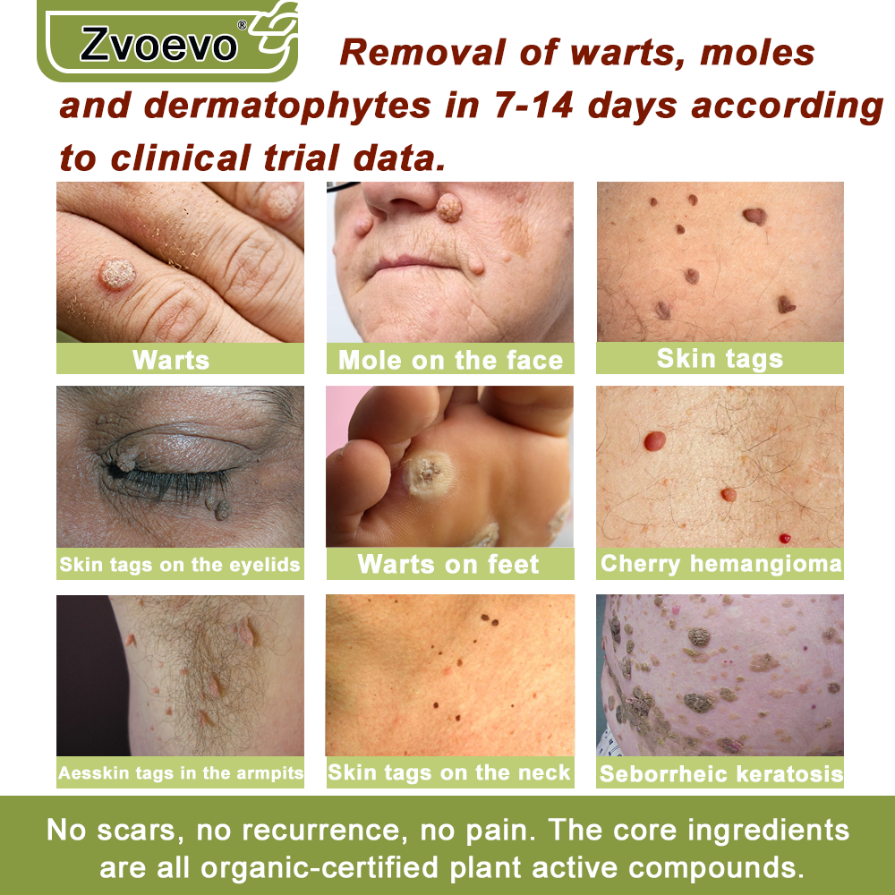 ✅ Official Store: Zvoevo® Magnesium Natural Repair Cream ⚕️ MHRA Certified – (Relief for Psoriasis, Eczema, Joint & Nerve Pain, Skin Repair, Even Tone, Acne & Dark Spot Treatment, Wart & Skin Tag Removal)