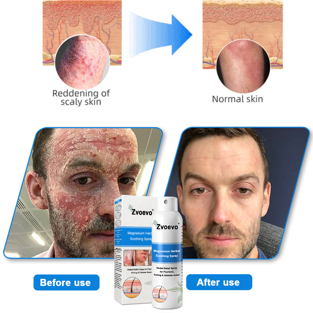 ✅Official Store: Zvoevo®Magnesium Herbal Spray⚕️MHRA Approved(Relief for Psoriasis and Eczema, Improvement of Bacterial Infections in the Genital Area, and Treatment of Acne and Dark Spots)