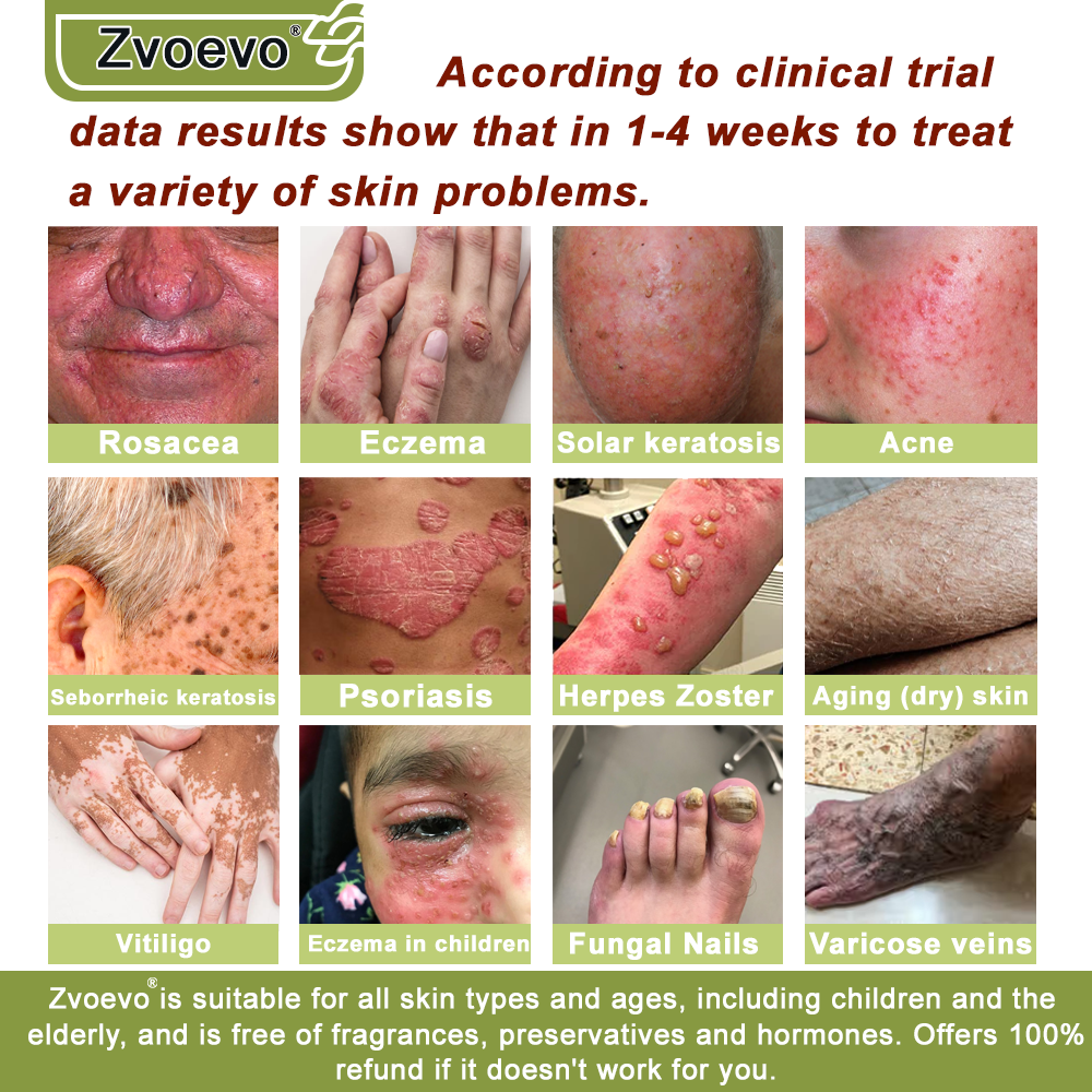 ✅ Official Store: Zvoevo® Magnesium Natural Repair Cream ⚕️ MHRA Certified – (Relief for Psoriasis, Eczema, Joint & Nerve Pain, Skin Repair, Even Tone, Acne & Dark Spot Treatment, Wart & Skin Tag Removal)
