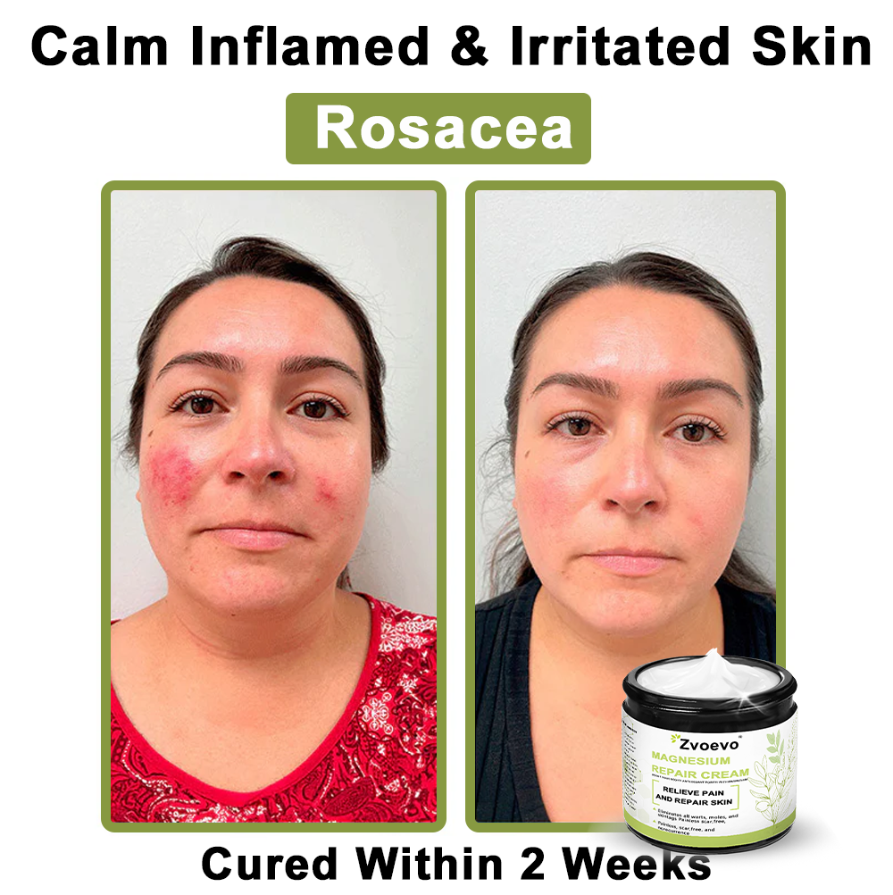 ✅ Official Store: Zvoevo® Magnesium Natural Repair Cream ⚕️ MHRA Certified – (Relief for Psoriasis, Eczema, Joint & Nerve Pain, Skin Repair, Even Tone, Acne & Dark Spot Treatment, Wart & Skin Tag Removal)
