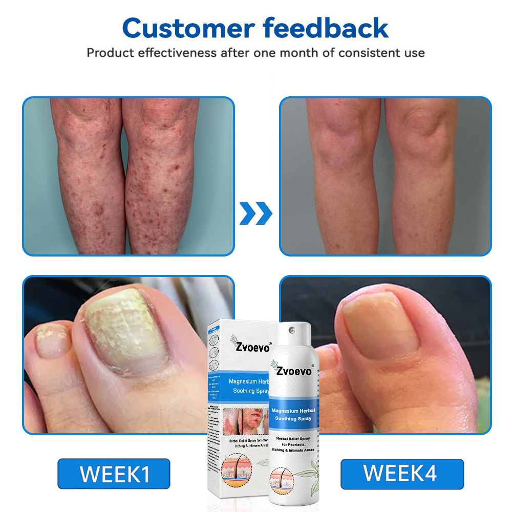 ✅Official Store: Zvoevo®Magnesium Herbal Spray⚕️MHRA Approved(Relief for Psoriasis and Eczema, Improvement of Bacterial Infections in the Genital Area, and Treatment of Acne and Dark Spots)