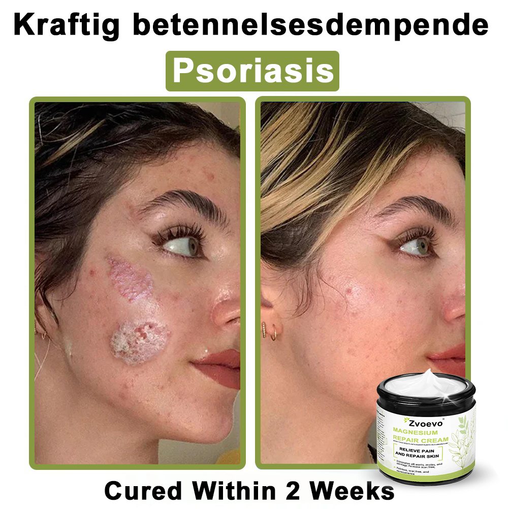 ✅ Official Store: Zvoevo® Magnesium Natural Repair Cream ⚕️ MHRA Certified – (Relief for Psoriasis, Eczema, Joint & Nerve Pain, Skin Repair, Even Tone, Acne & Dark Spot Treatment, Wart & Skin Tag Removal)