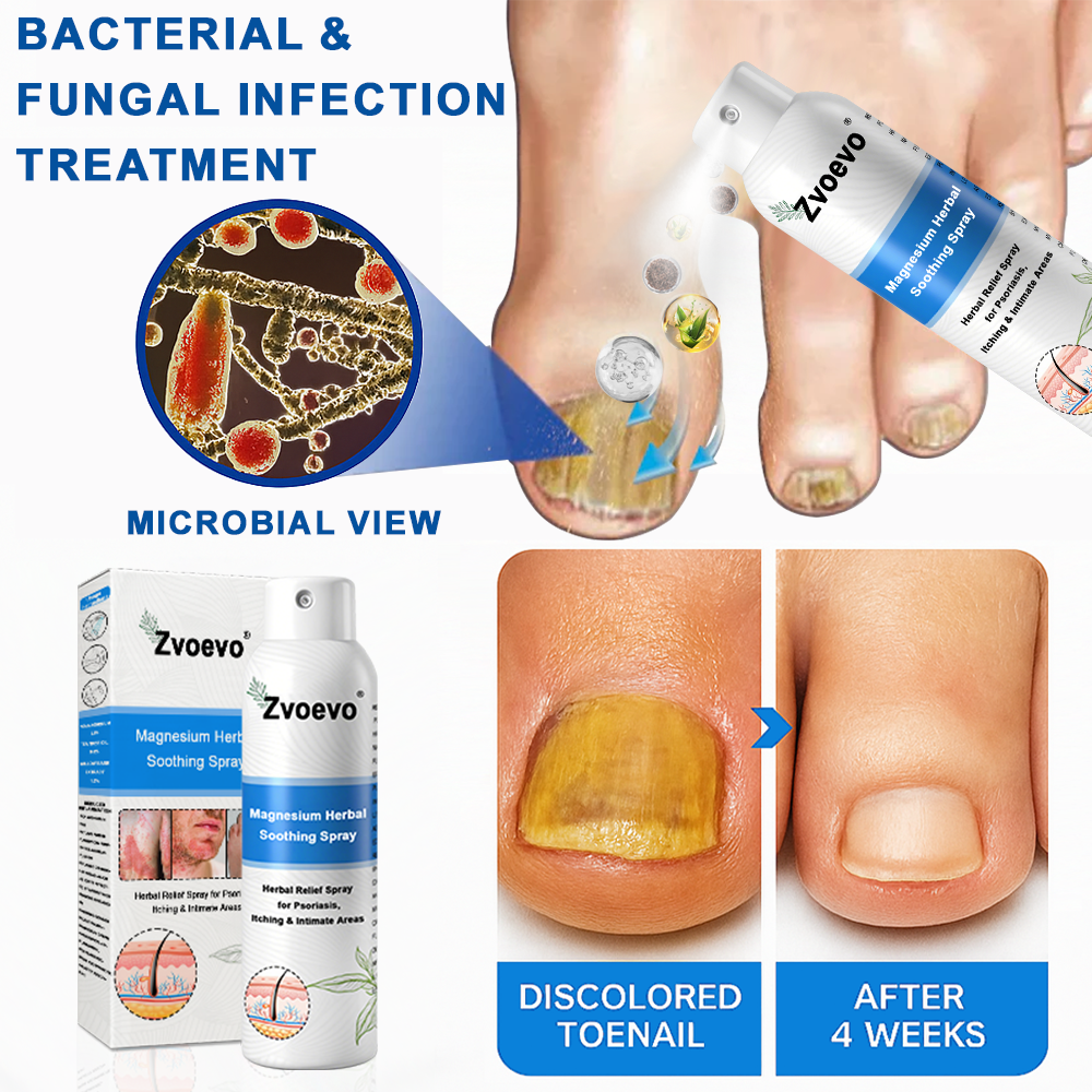 ✅Official Store: Zvoevo®Magnesium Herbal Spray⚕️MHRA Approved(Relief for Psoriasis and Eczema, Improvement of Bacterial Infections in the Genital Area, and Treatment of Acne and Dark Spots)