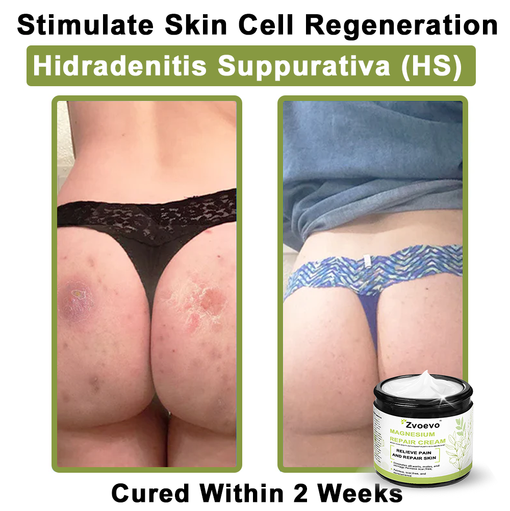 ✅ Official Store: Zvoevo® Magnesium Natural Repair Cream ⚕️ MHRA Certified – (Relief for Psoriasis, Eczema, Joint & Nerve Pain, Skin Repair, Even Tone, Acne & Dark Spot Treatment, Wart & Skin Tag Removal)