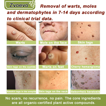 ✅ Official Store: Zvoevo® Magnesium Natural Repair Cream ⚕️ MHRA Certified – (Relief for Psoriasis, Eczema, Joint & Nerve Pain, Skin Repair, Even Tone, Acne & Dark Spot Treatment, Wart & Skin Tag Removal)
