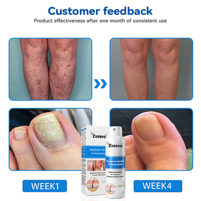 ✅Official Store: Zvoevo®Magnesium Herbal Spray⚕️MHRA Approved(Relief for Psoriasis and Eczema, Improvement of Bacterial Infections in the Genital Area, and Treatment of Acne and Dark Spots)