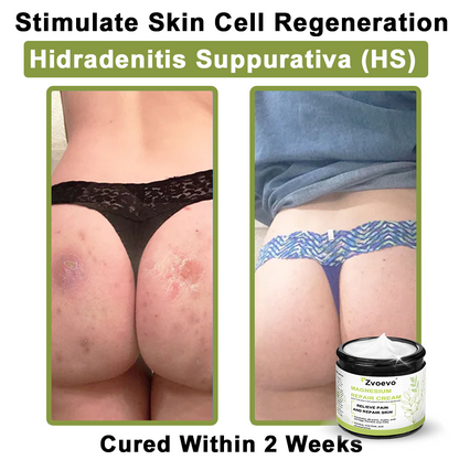 ✅ Official Store: Zvoevo® Magnesium Natural Repair Cream ⚕️ MHRA Certified – (Relief for Psoriasis, Eczema, Joint & Nerve Pain, Skin Repair, Even Tone, Acne & Dark Spot Treatment, Wart & Skin Tag Removal)